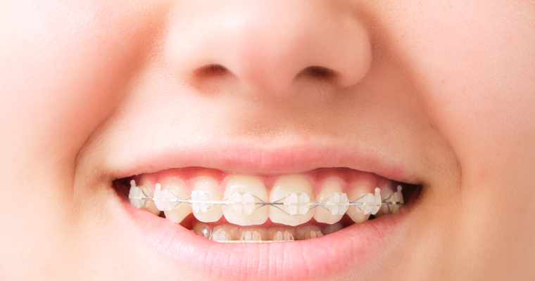 5 Factors for Finding Your Perfect Orthodontist