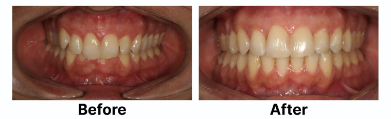 How Our Patient Overcame Their Fear of Braces With Clear Aligners